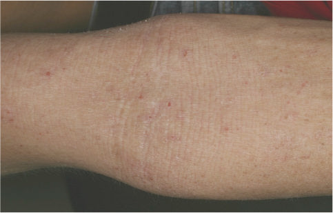 【ドクターズコラム】ダニアレルギーが関与する代表的アレルギー「アトピー性皮膚炎」とは？